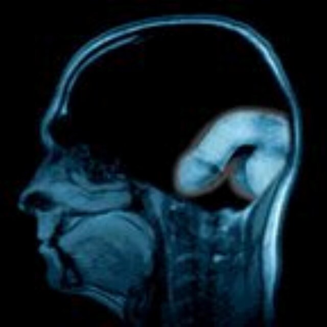 Broken Bones minor changes