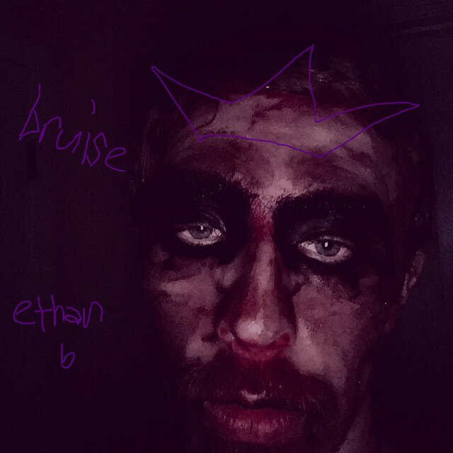 bruise