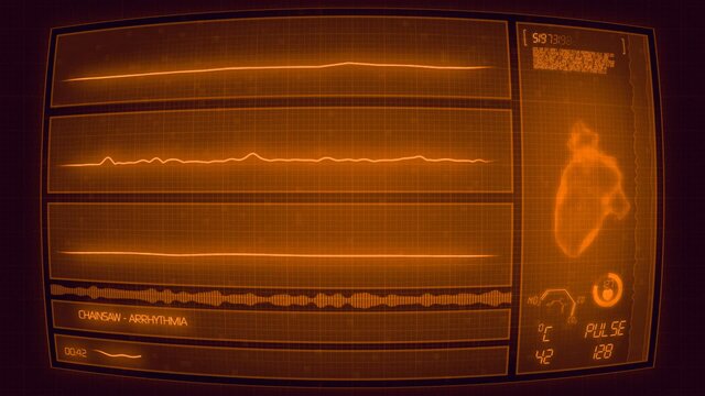 Arrhythmia