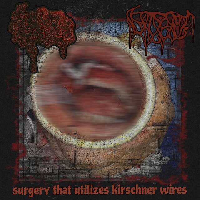 Surgery That Utilises Kirschner Wires