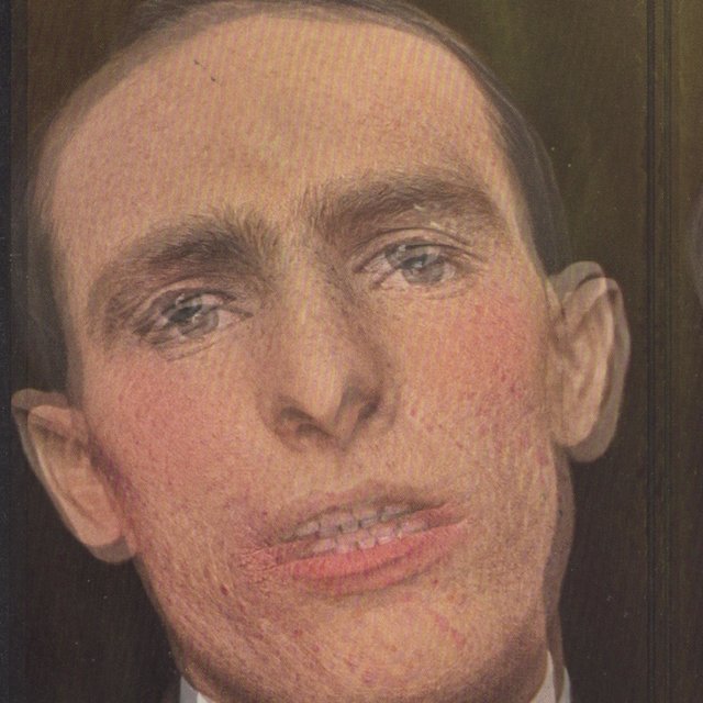 Burns