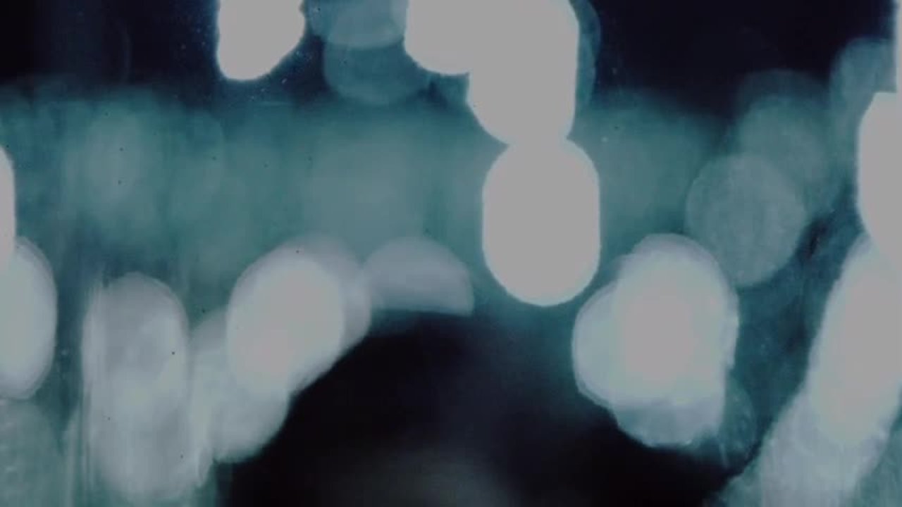 Drowning