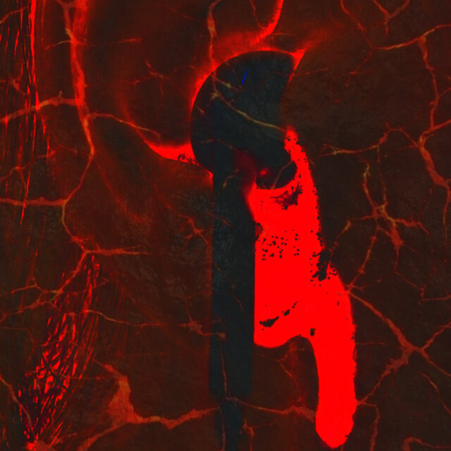 Ruptured Eardrum