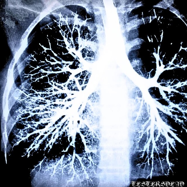 Bronchitis