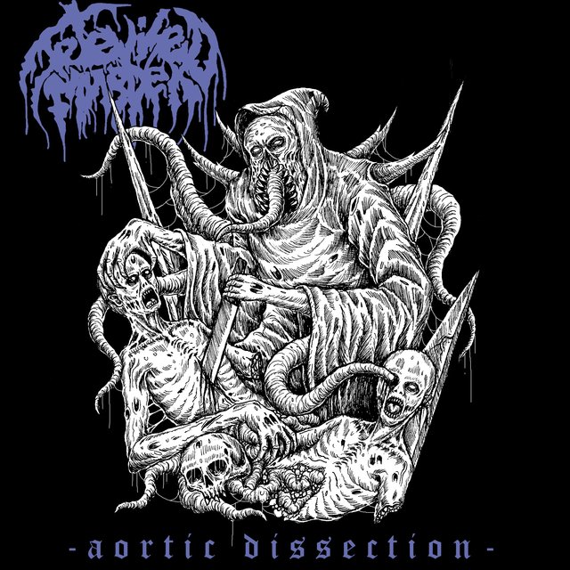 Aortic Dissection