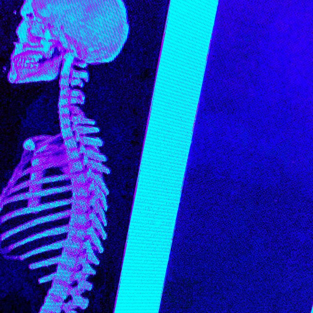 Smart and Spinal
