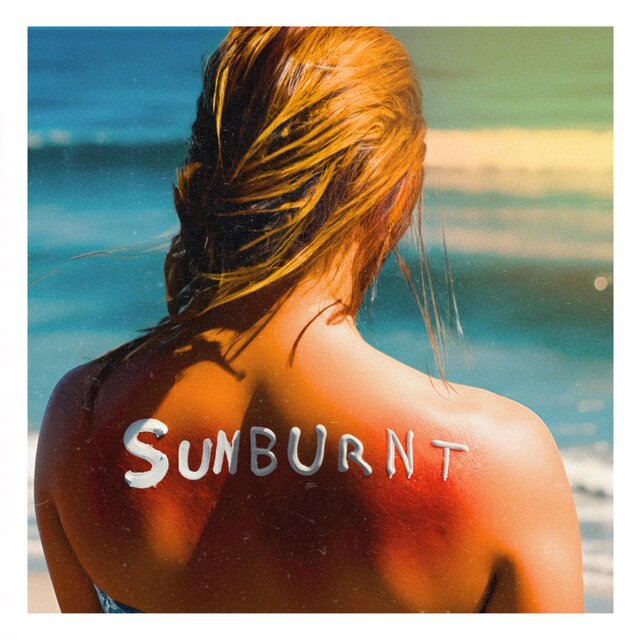 SUNBURNT