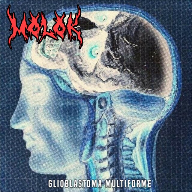 GLIOBLASTOMA MULTIFORME