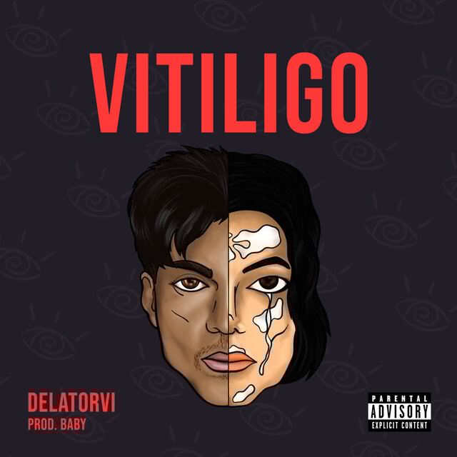 Vitiligo
