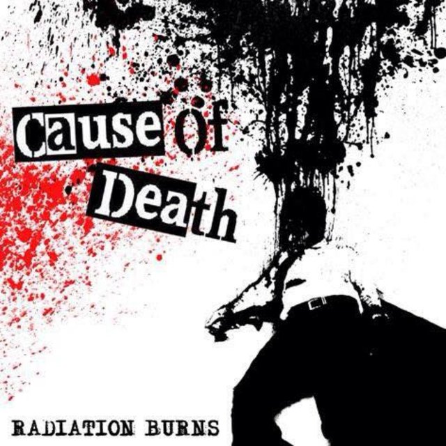 Radiation Burns